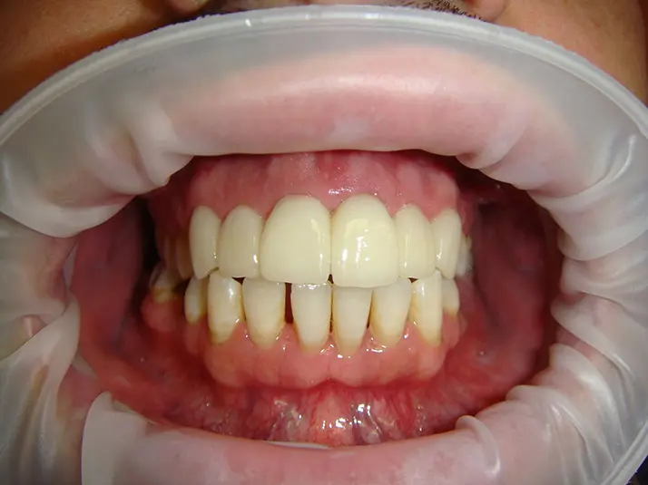 Dentist Alexandria VA Case 23 Before