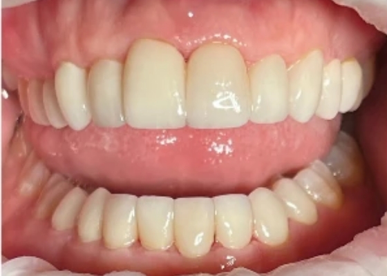 Dentist Alexandria VA Case 27 Before Ultra Thin Veneers