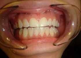 Dentist Alexandria VA Case Study 37 Before Smile