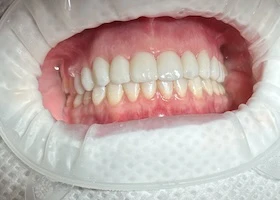 Dentist Alexandria VA Case Study 45 Before