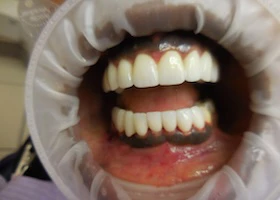 Dentist Alexandria VA Case Study 48 Before Face