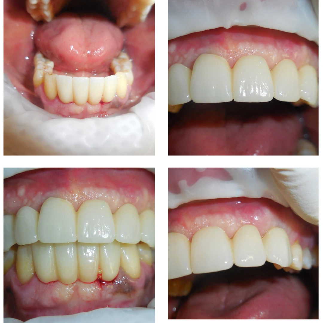 Case Study 5 Implant Supported Bridges