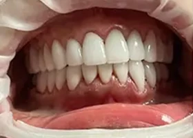 Dentist Alexandria VA Case 6 Full Mouth Rehab