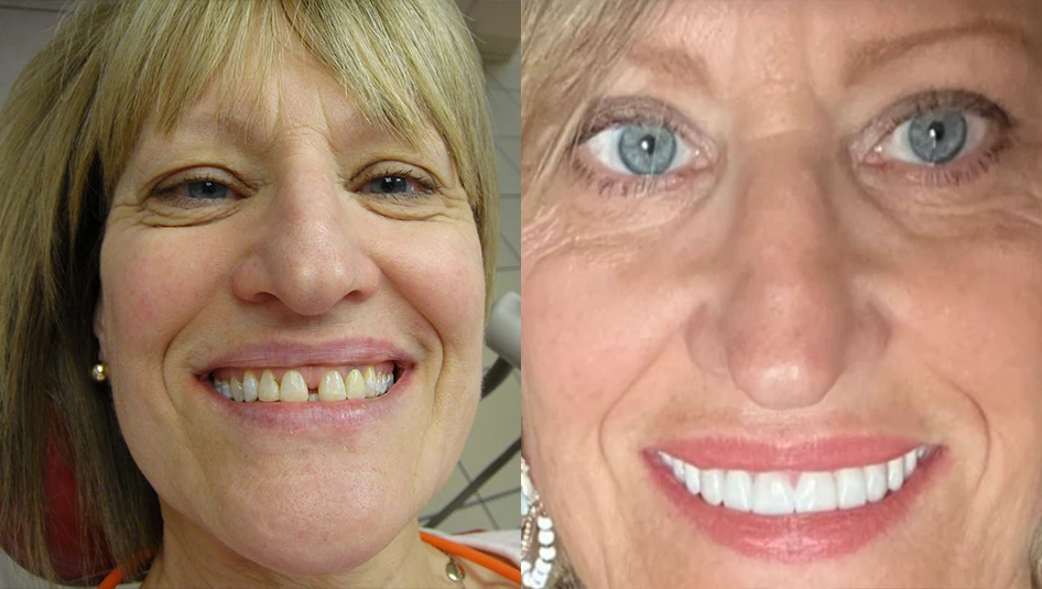 Woman smiling in the dental treatment chair