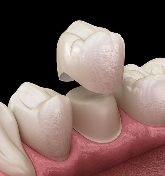 A CGI image of a dental crown being placed on a tooth