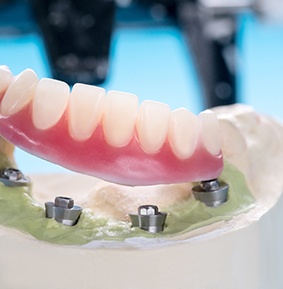 Cast base with 4 dental implants and a lower arch of dentures